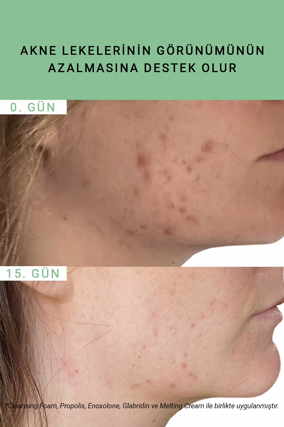 Pure Active Propolis Akne Karşıtı Antienflamatuar & Yatıştırıcı Etkili Saf Cilt Serumu 15 ML 4 Pure Active Propolis Akne Karşıtı Antienflamatuar & Yatıştırıcı Etkili Saf Cilt Serumu 15 ML